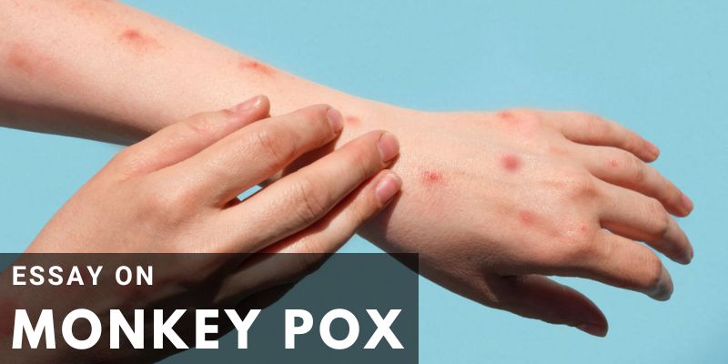 You are currently viewing Essay on Monkey pox